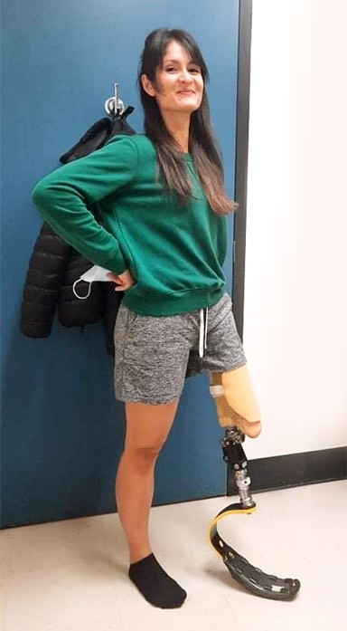 An adult female leg and arm amputee stands in a prosthetist’s office.